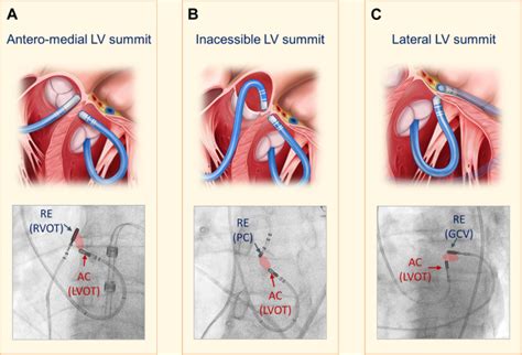 lv pvc|How to map and ablate left ventricular summit .